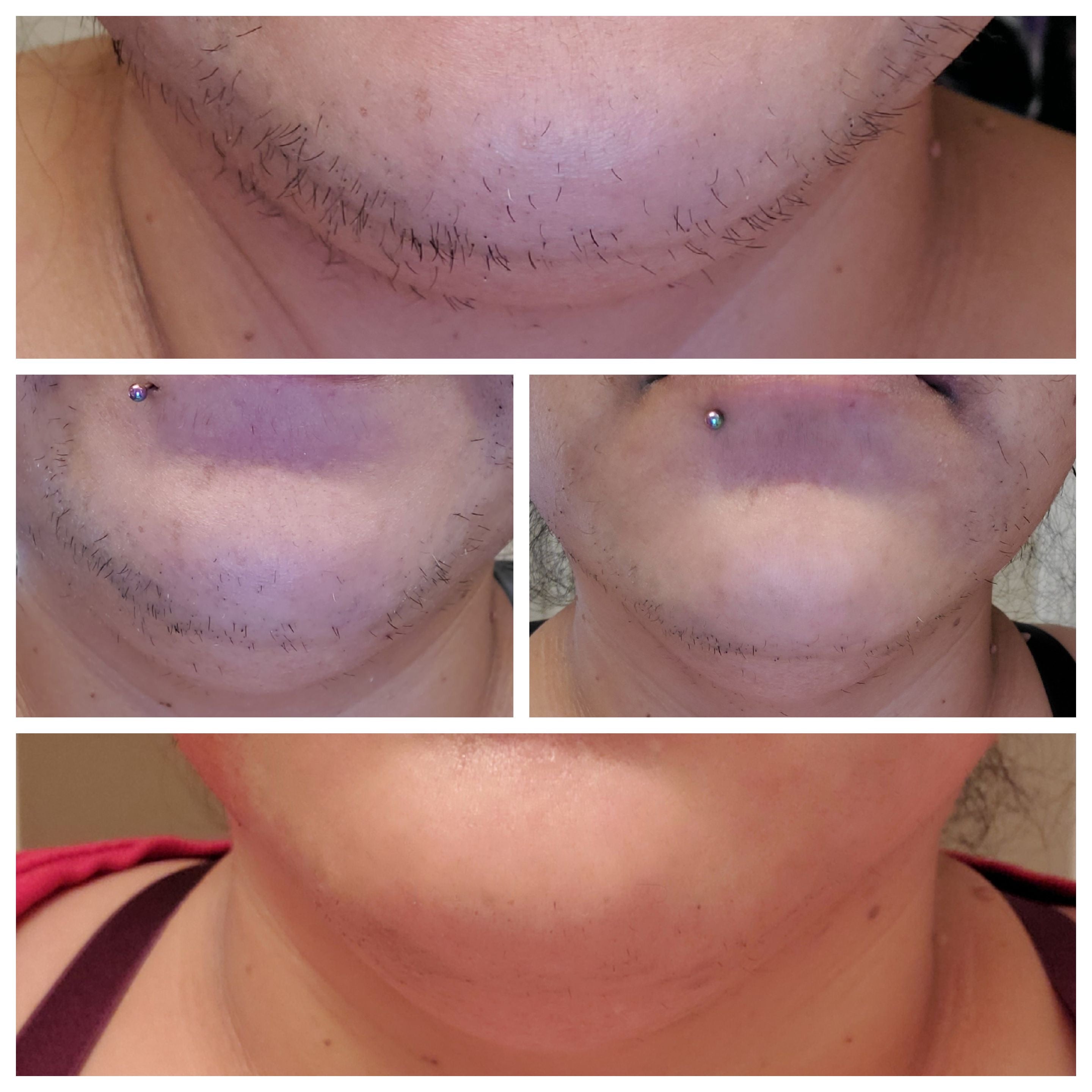 Why does PCOS cause facial hair ?