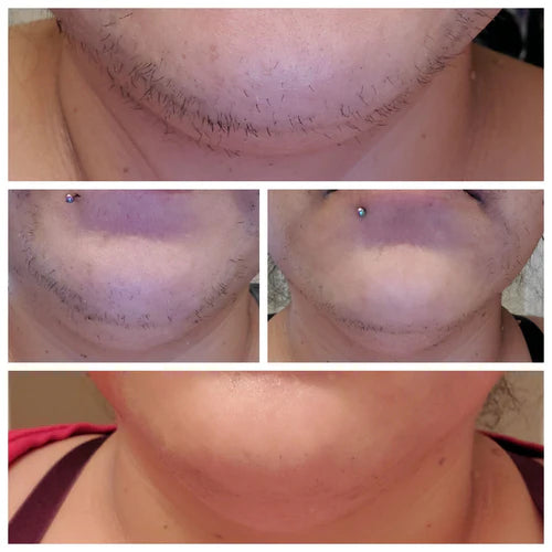 Shaving-your-face-due-to-PCOS PolyC's Premium PCOS